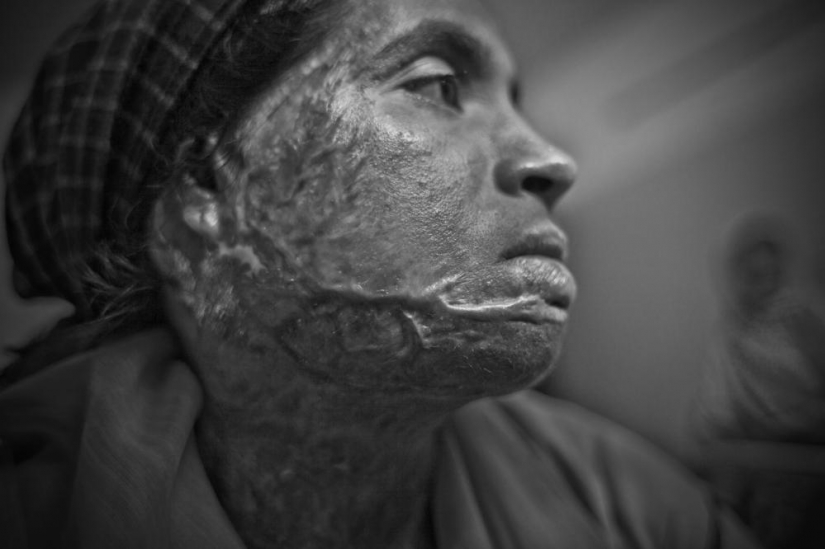 The education of acid in Bangladesh The education of acid in Bangladesh