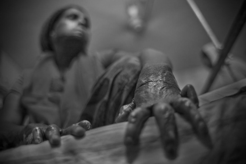 The education of acid in Bangladesh The education of acid in Bangladesh