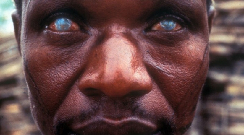 10 most terrifying parasites that can live in the human body