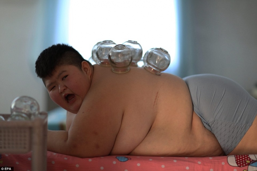 11-year-old Chinese man weighing 150 pounds trying to lose weight with the help of fire
