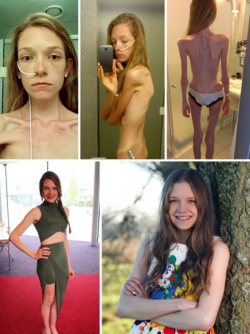 Antes y después: 20 ejemplos de personas que lograron superar la anorexia Antes y después: 20 ejemplos de personas que lograron superar la anorexia