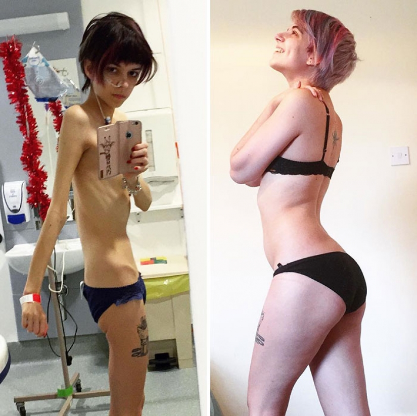 Antes y después: 20 ejemplos de personas que lograron superar la anorexia Antes y después: 20 ejemplos de personas que lograron superar la anorexia