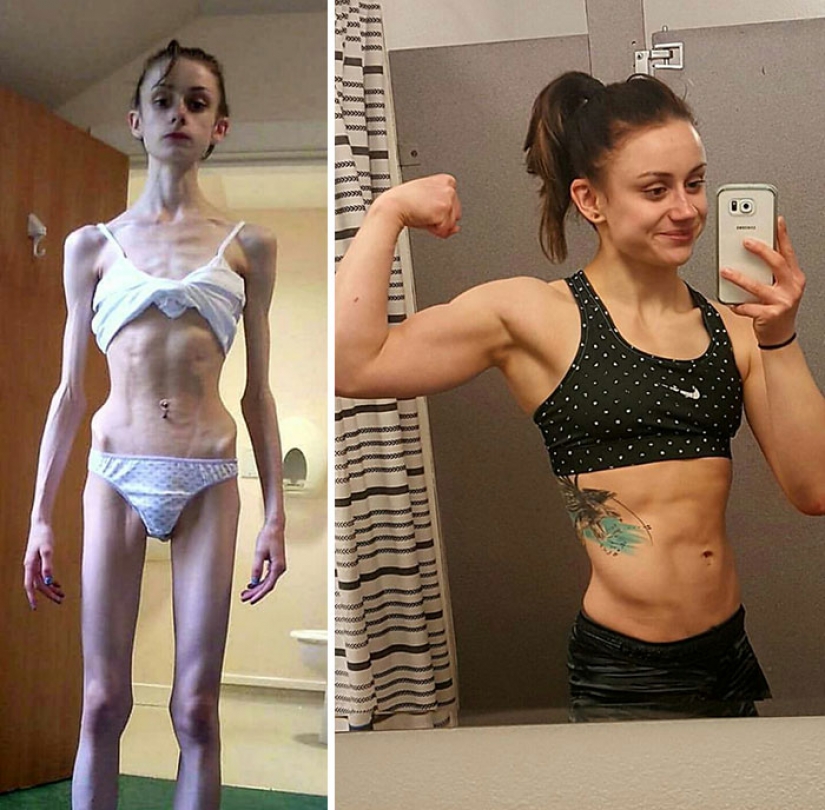 Antes y después: 20 ejemplos de personas que lograron superar la anorexia Antes y después: 20 ejemplos de personas que lograron superar la anorexia