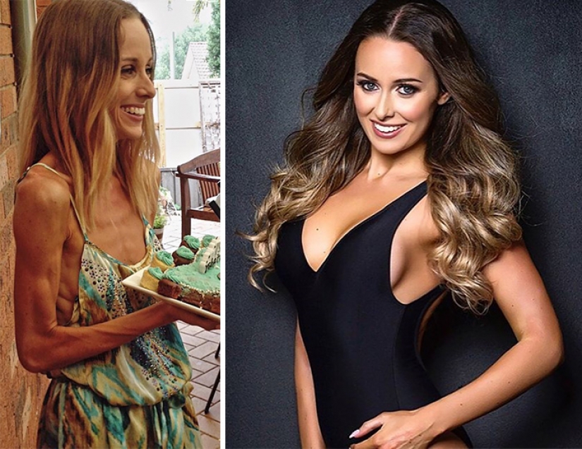 Antes y después: 20 ejemplos de personas que lograron superar la anorexia Antes y después: 20 ejemplos de personas que lograron superar la anorexia