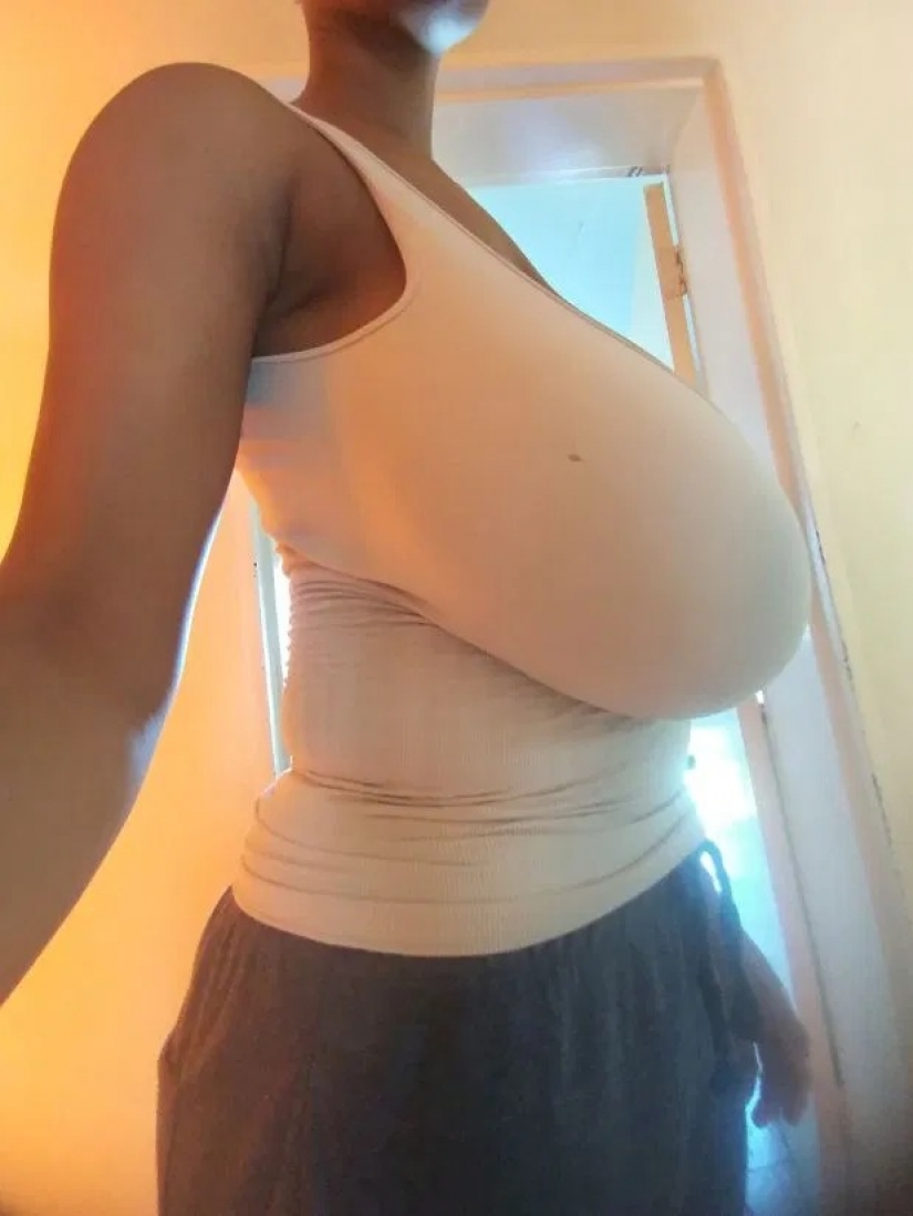 As the stone with soul: the life of a girl with 13 breast size has changed dramatically after surgery for reducing bust