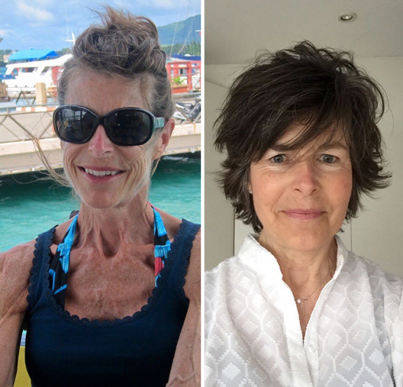 Before and after: 20 examples of people who managed to overcome anorexia Before and after: 20 examples of people who managed to overcome anorexia