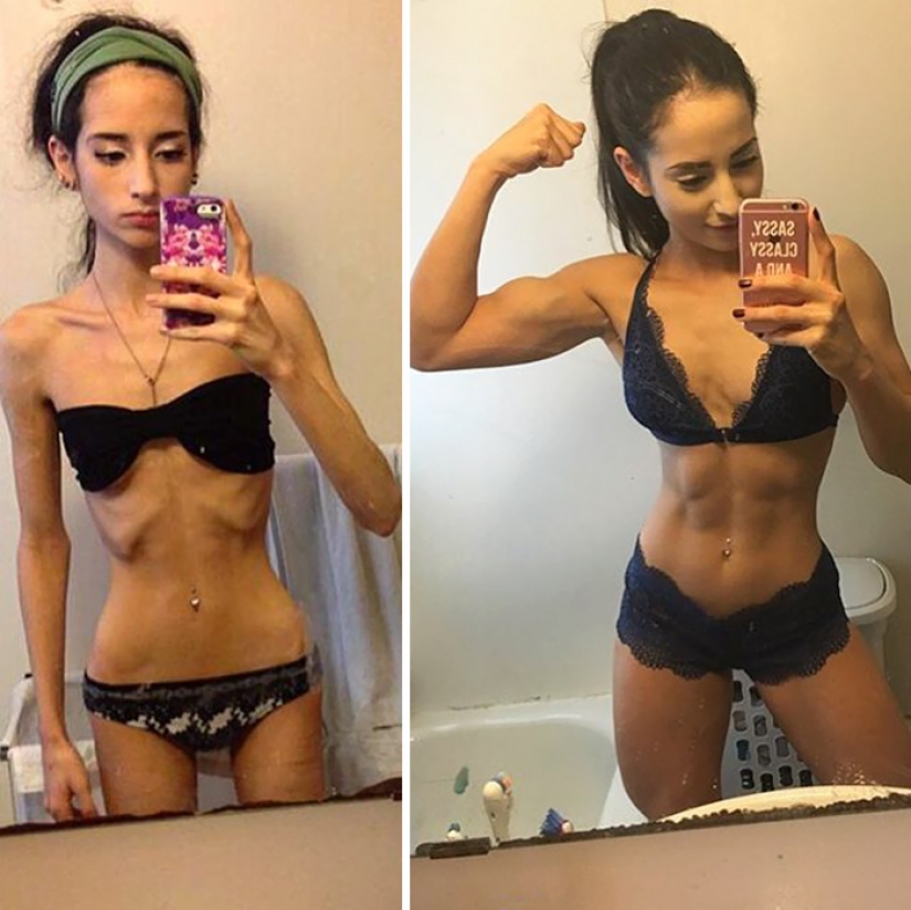 Before and after: 20 examples of people who managed to overcome anorexia Before and after: 20 examples of people who managed to overcome anorexia