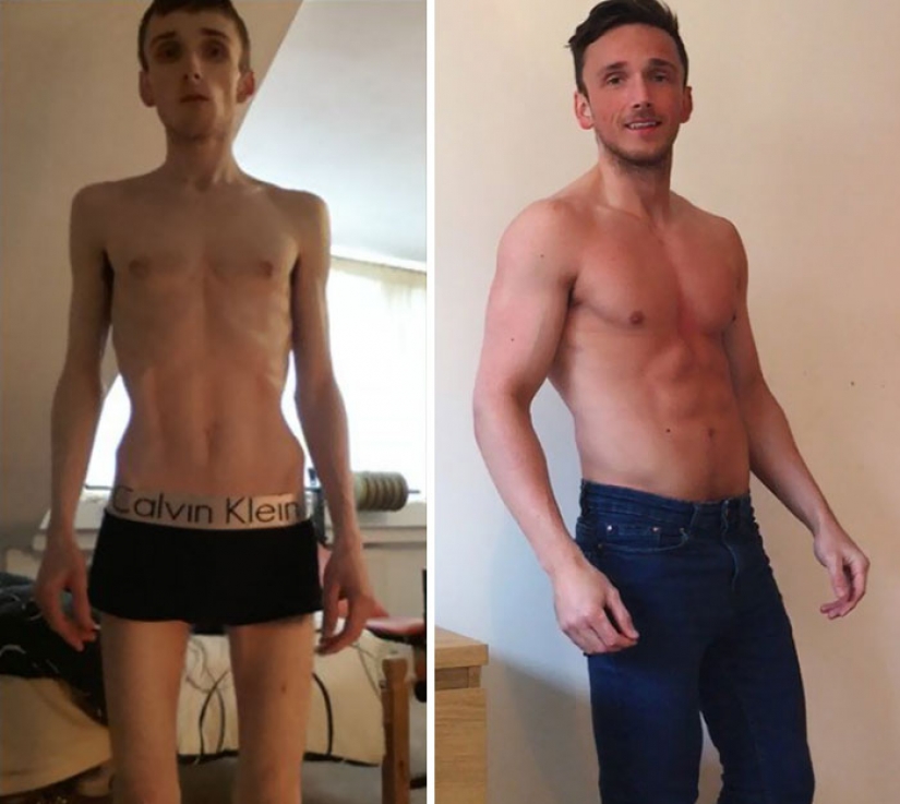 Before and after: 20 examples of people who managed to overcome anorexia Before and after: 20 examples of people who managed to overcome anorexia