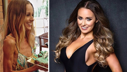 Before and after: 20 examples of people who managed to overcome anorexia