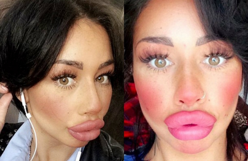 British dumplings: a single mother from Liverpool has spent nearly 2 thousand pounds for a swap of the lips and cannot stop