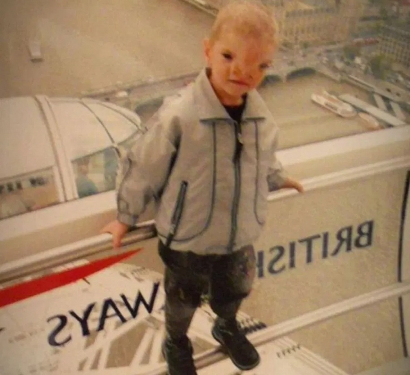 British soldiers raised money for an operation for a boy from Bosnia, who was born with a rare defect on the face