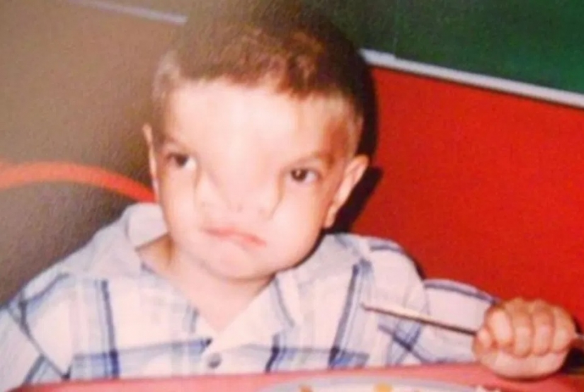 British soldiers raised money for an operation for a boy from Bosnia, who was born with a rare defect on the face