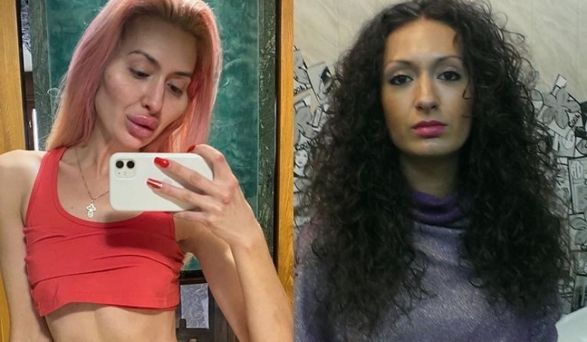 Cheeks-barrels: from Kiev itself injects fillers to be special