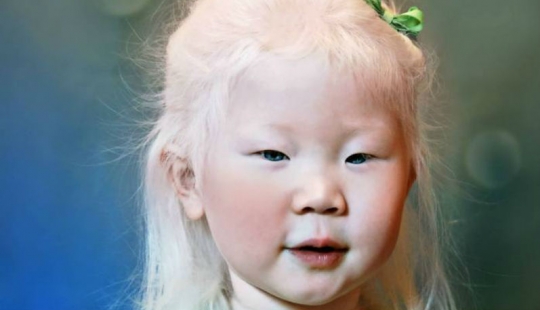 Cómo son los albinos diferentes nacionalidades y razas