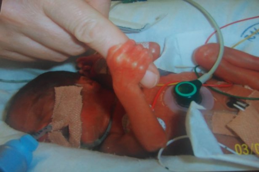 Connected by a single destiny: the miracle twins who were born with a break of 87 days Connected by a single destiny: the miracle twins who were born with a break of 87 days