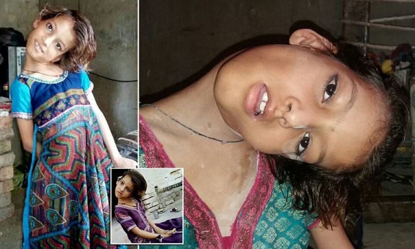 El mundo está en un ángulo recto: cuello de 11 años Pakistaní girado 90 grados El mundo está en un ángulo recto: cuello de 11 años Pakistaní girado 90 grados