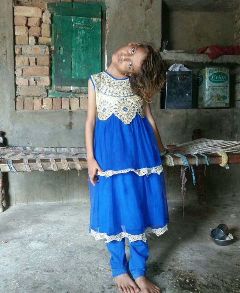 El mundo está en un ángulo recto: cuello de 11 años Pakistaní girado 90 grados El mundo está en un ángulo recto: cuello de 11 años Pakistaní girado 90 grados