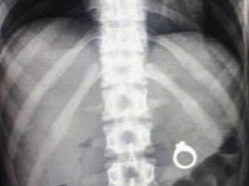 El peor de los artículos que han encontrado alguna vez en un estómago humano El peor de los artículos que han encontrado alguna vez en un estómago humano