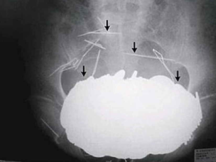 El peor de los artículos que han encontrado alguna vez en un estómago humano El peor de los artículos que han encontrado alguna vez en un estómago humano