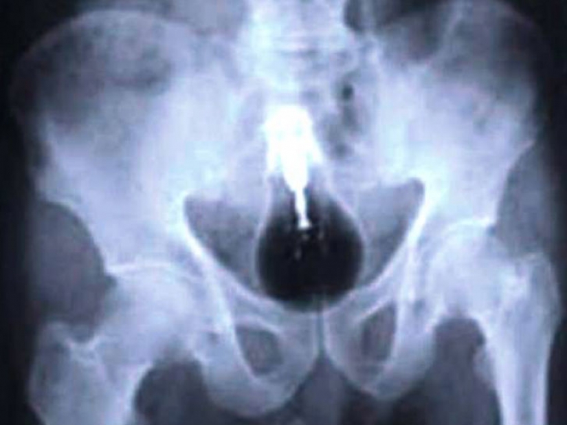 El peor de los artículos que han encontrado alguna vez en un estómago humano El peor de los artículos que han encontrado alguna vez en un estómago humano