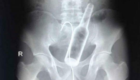 El peor de los artículos que han encontrado alguna vez en un estómago humano