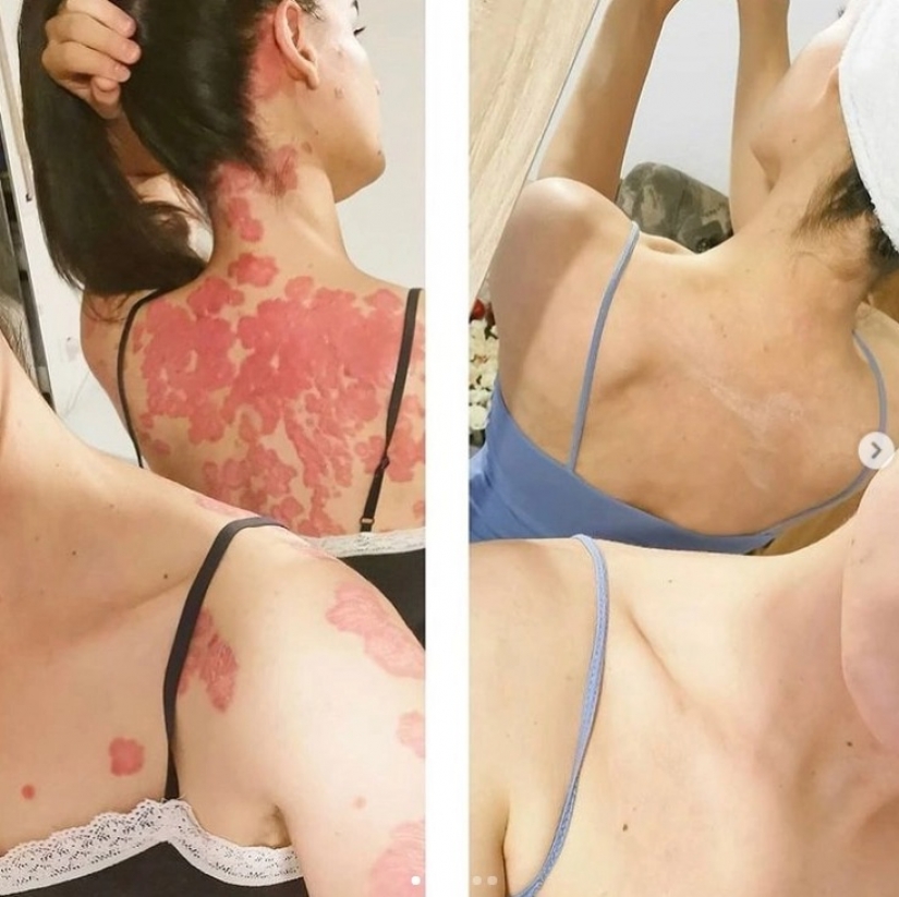 Ella se curó de la psoriasis, gracias al milagro de la dieta, y ahora su método ayuda a miles