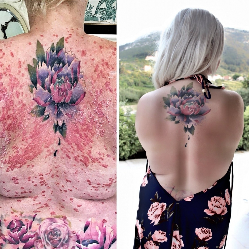 Ella se curó de la psoriasis, gracias al milagro de la dieta, y ahora su método ayuda a miles