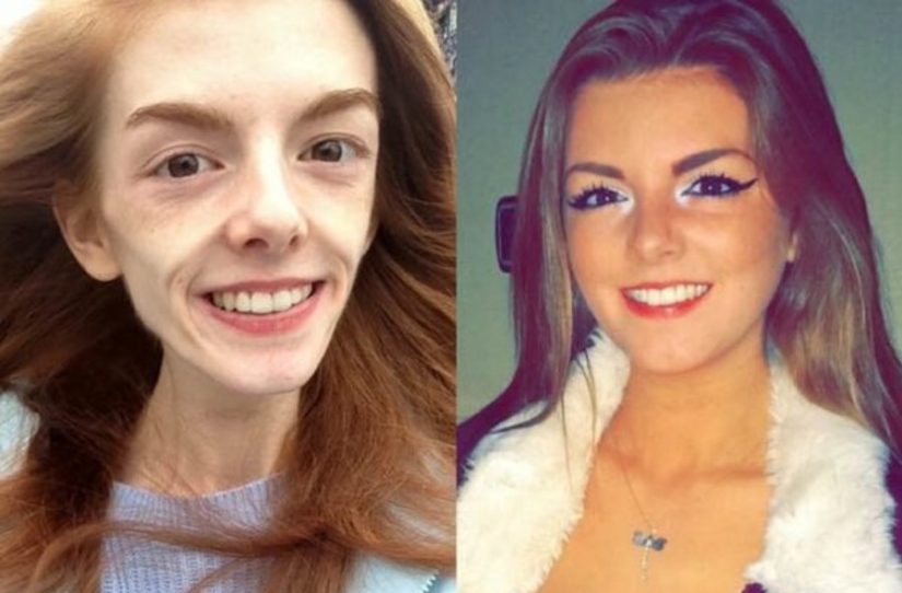 Girl with a weight of 29 kg defeated anorexia with chocolate