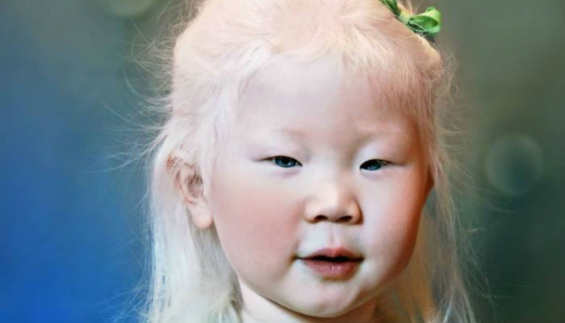 How are albinos different nationalities and races How are albinos different nationalities and races