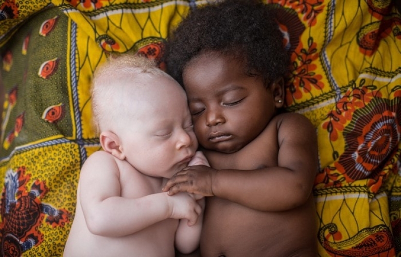 How are albinos different nationalities and races How are albinos different nationalities and races