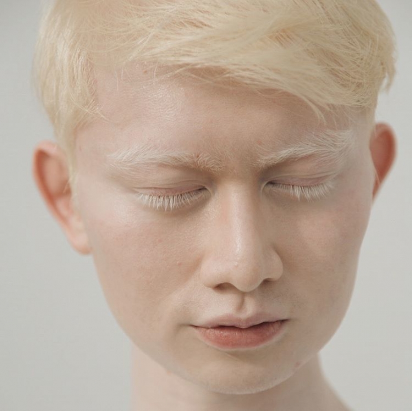 How are albinos different nationalities and races How are albinos different nationalities and races