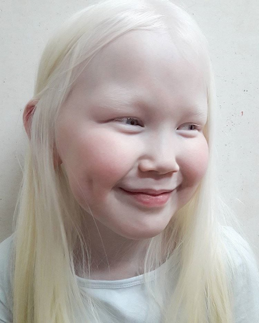 How are albinos different nationalities and races How are albinos different nationalities and races