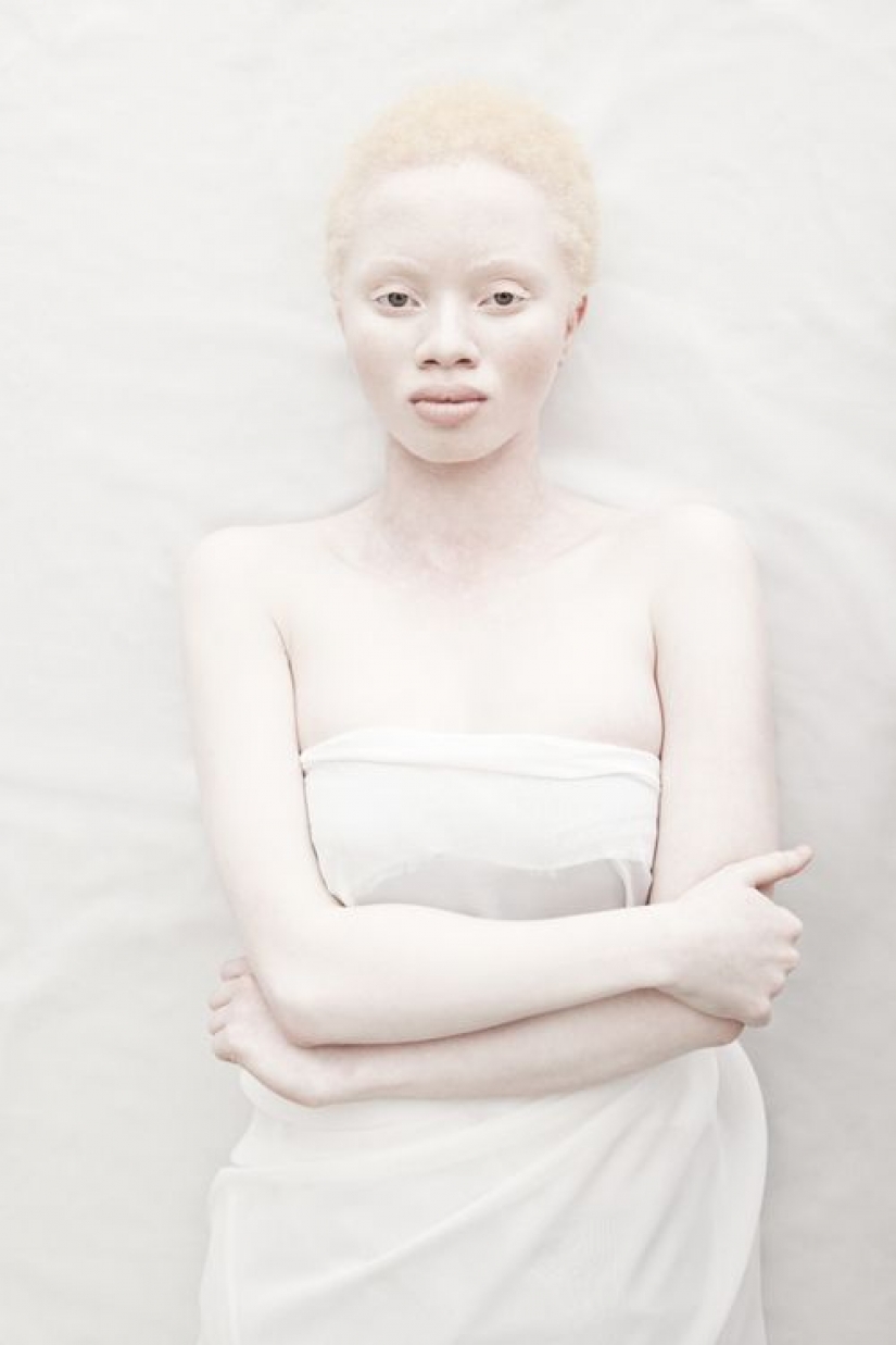 How are albinos different nationalities and races How are albinos different nationalities and races