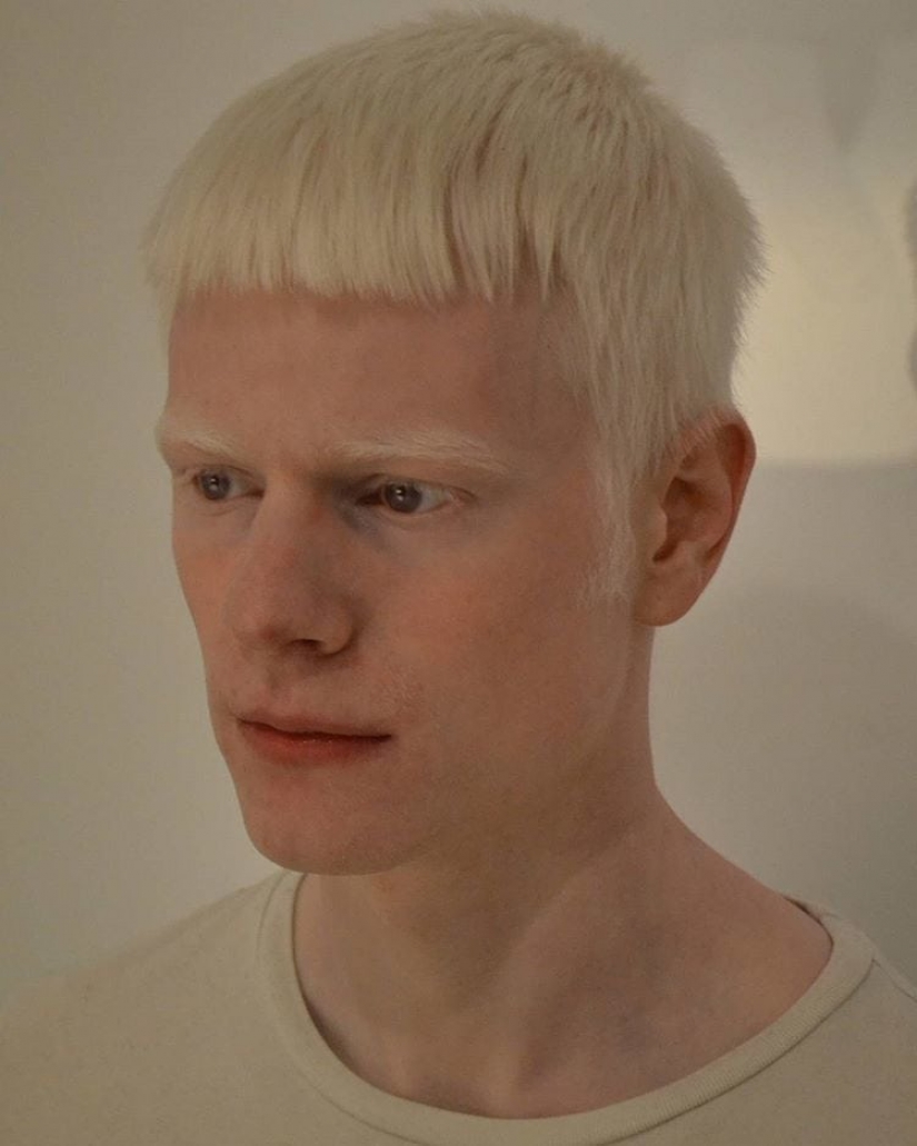 How are albinos different nationalities and races How are albinos different nationalities and races