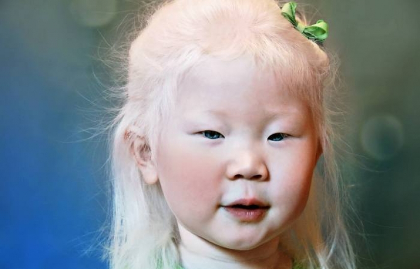 How are albinos different nationalities and races How are albinos different nationalities and races