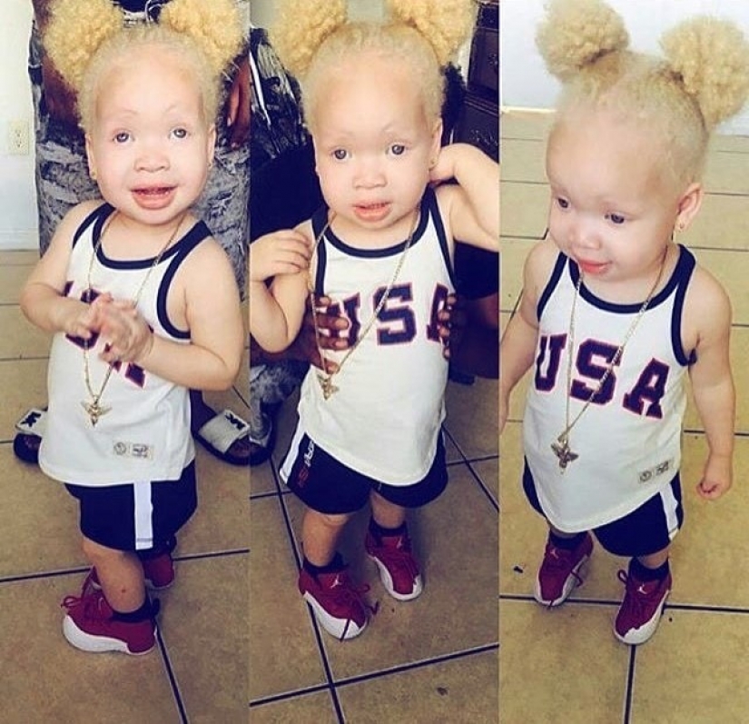 How are albinos different nationalities and races How are albinos different nationalities and races