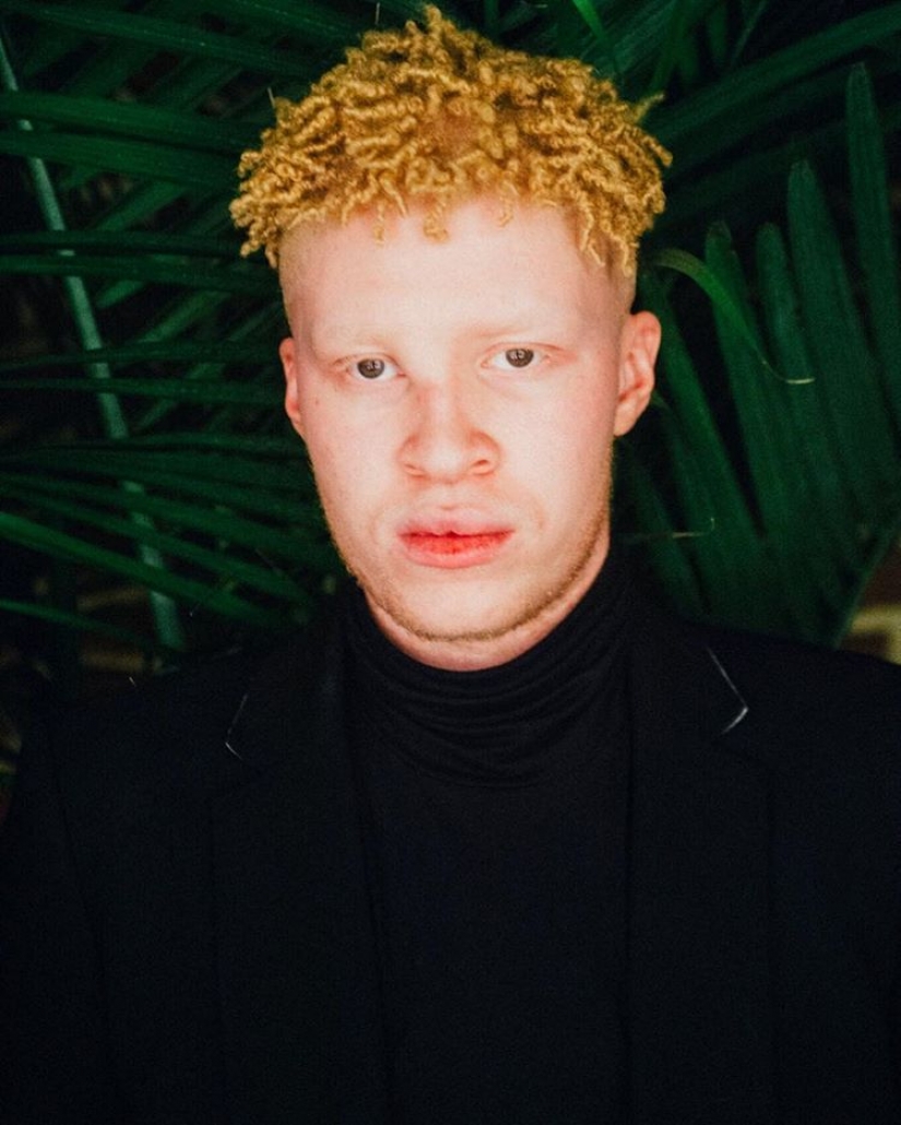 How are albinos different nationalities and races How are albinos different nationalities and races