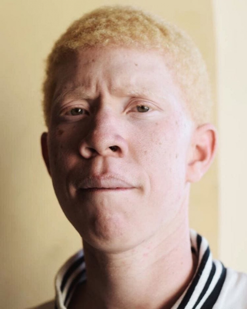 How are albinos different nationalities and races How are albinos different nationalities and races