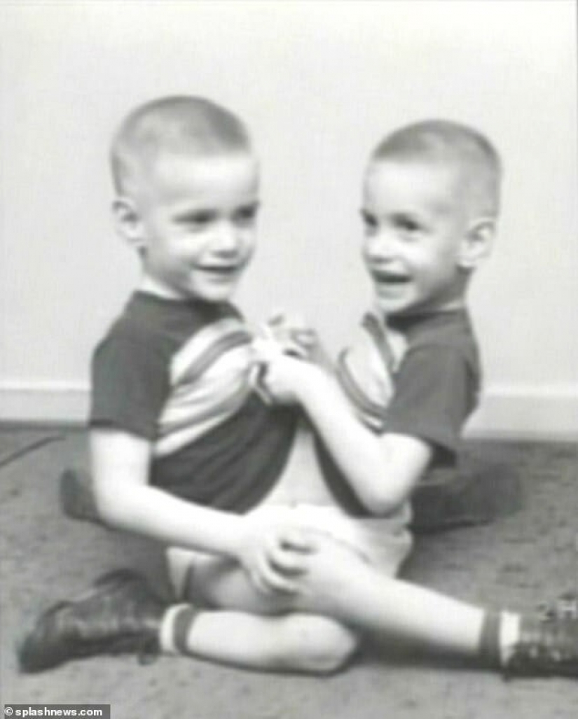 In the United States died the oldest conjoined twins Ronnie and Donnie Gelion In the United States died the oldest conjoined twins Ronnie and Donnie Gelion
