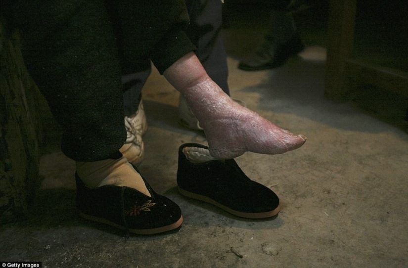 In the village of "bound feet" the last living Chinese women suffering from the ancient brutal tradition