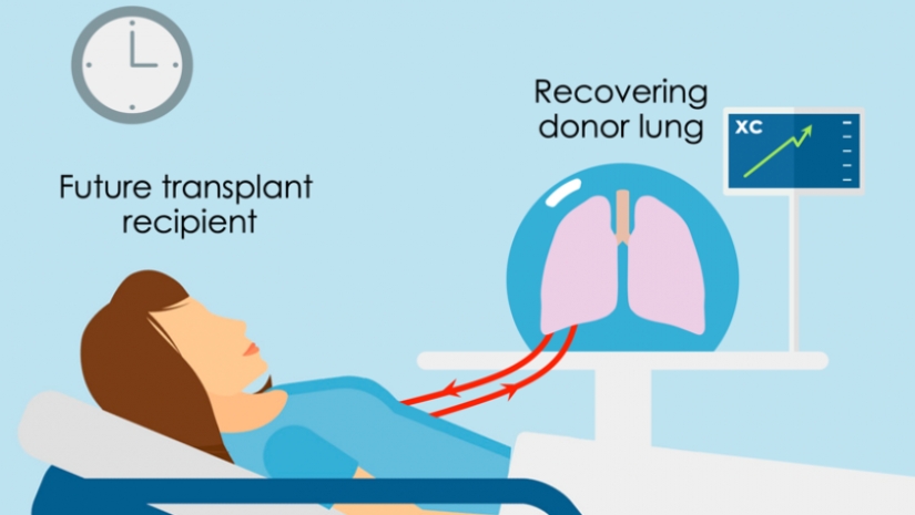 Los científicos se han restaurado los afectados los pulmones de una persona, la conexión a los cerdos Los científicos se han restaurado los afectados los pulmones de una persona, la conexión a los cerdos