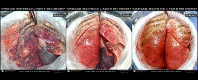 Los científicos se han restaurado los afectados los pulmones de una persona, la conexión a los cerdos Los científicos se han restaurado los afectados los pulmones de una persona, la conexión a los cerdos
