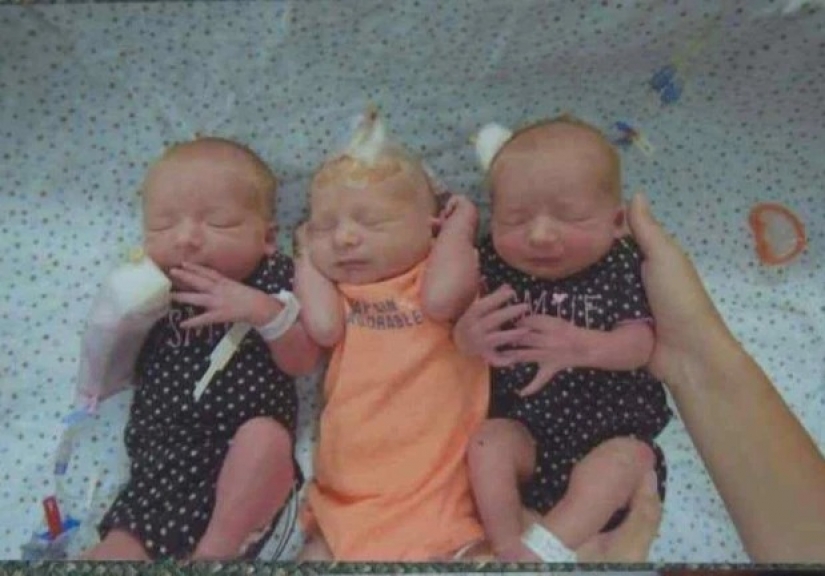 Non-random accident: a woman gave birth to triplets, not knowing about the pregnancy
