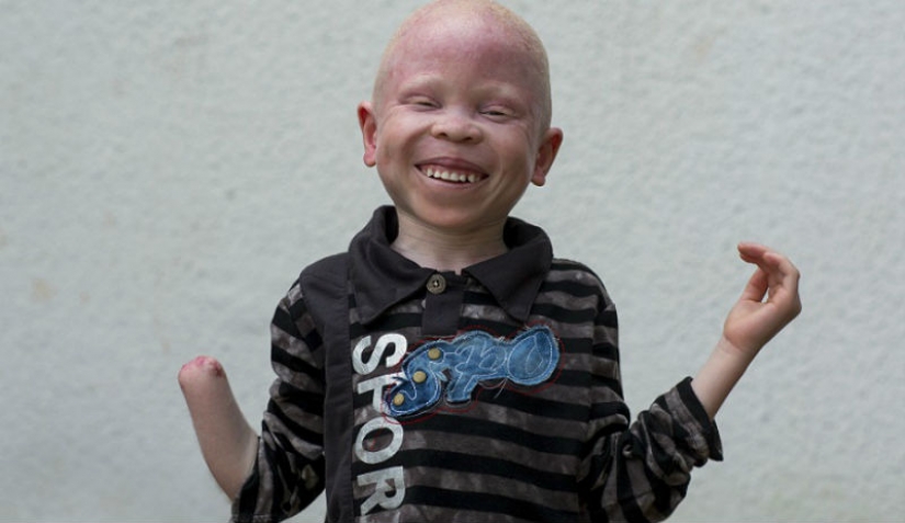 Tanzanian albinos, whose bodies are worth more than gold Tanzanian albinos, whose bodies are worth more than gold