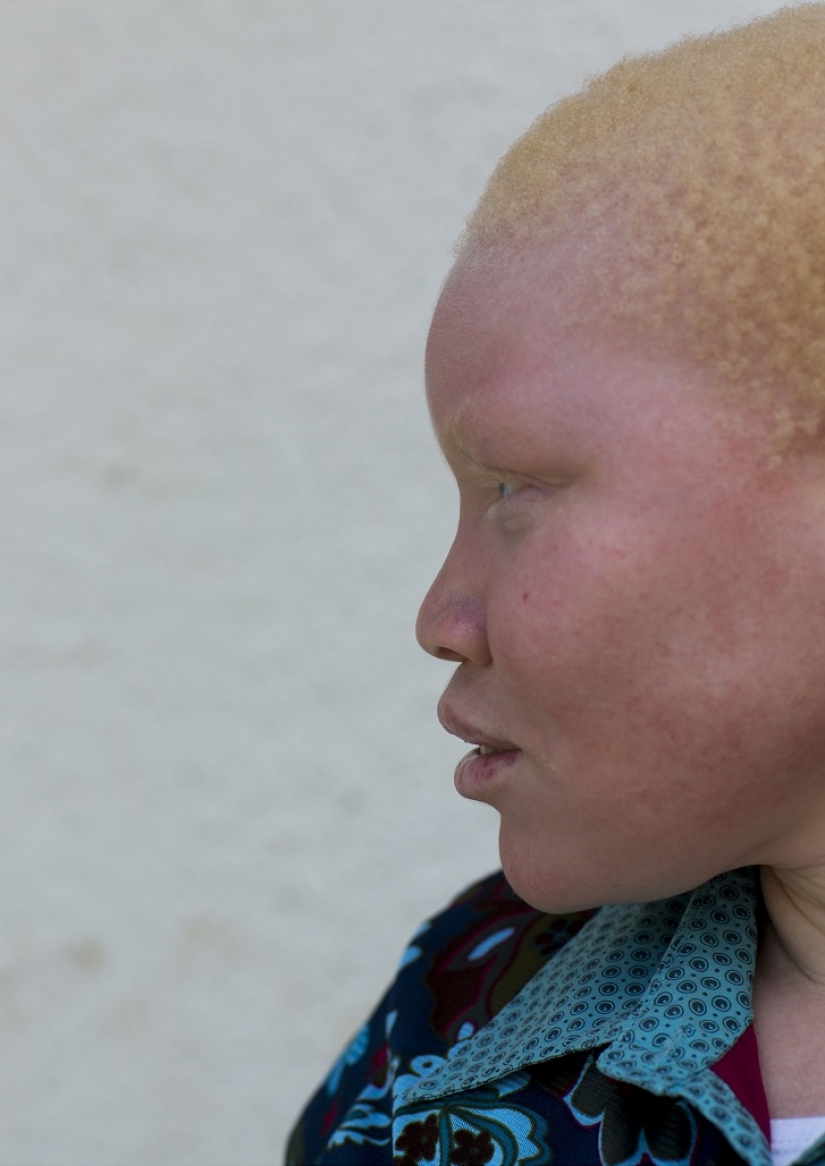Tanzanian albinos, whose bodies are worth more than gold Tanzanian albinos, whose bodies are worth more than gold