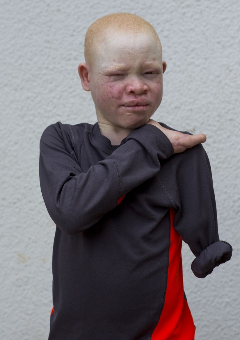 Tanzanian albinos, whose bodies are worth more than gold Tanzanian albinos, whose bodies are worth more than gold