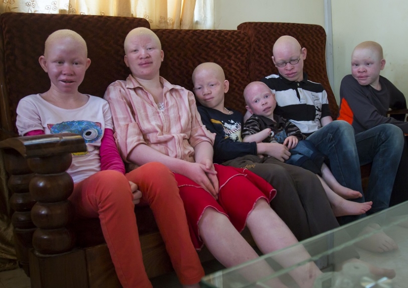 Tanzanian albinos, whose bodies are worth more than gold Tanzanian albinos, whose bodies are worth more than gold