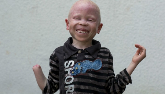 Tanzanian albinos, whose bodies are worth more than gold