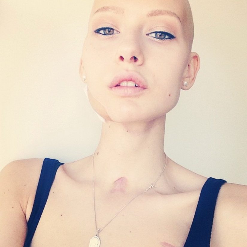 The doctors told the model to have an abortion after she has deleted 95% of the jaw to cancer — and that's what she did The doctors told the model to have an abortion after she has deleted 95% of the jaw to cancer — and that's what she did