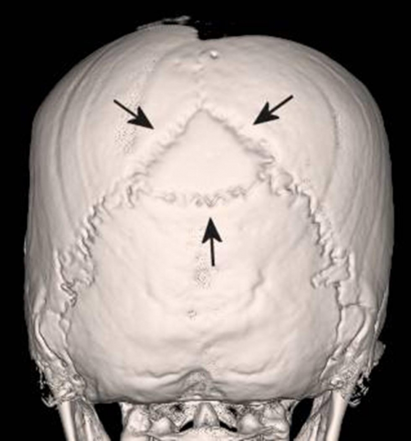 The Inca mummies of sacrificed children and women The Inca mummies of sacrificed children and women